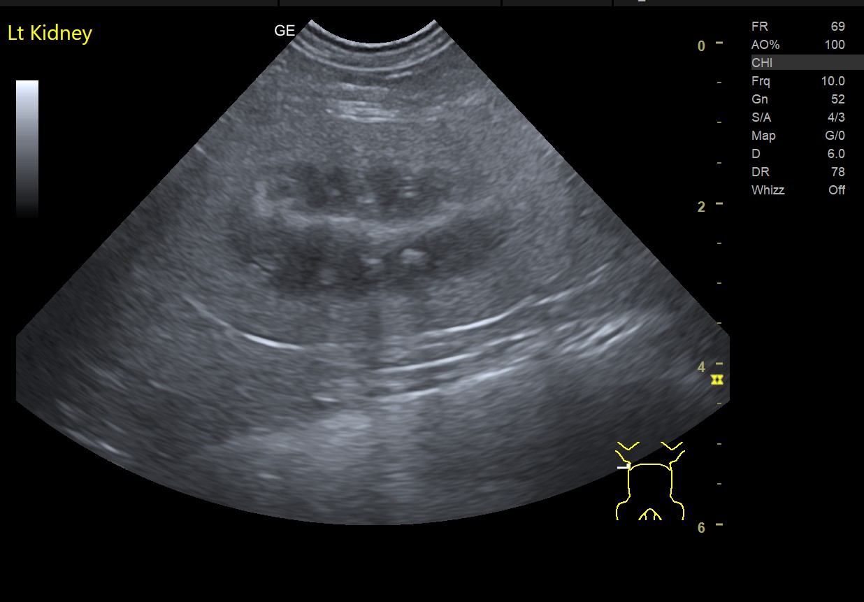 Ultrasound image of a left kidney