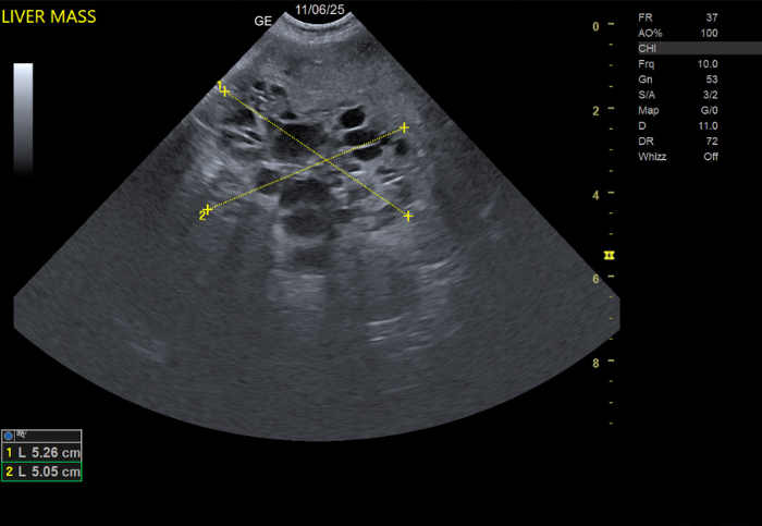 x-ray of a liver mass